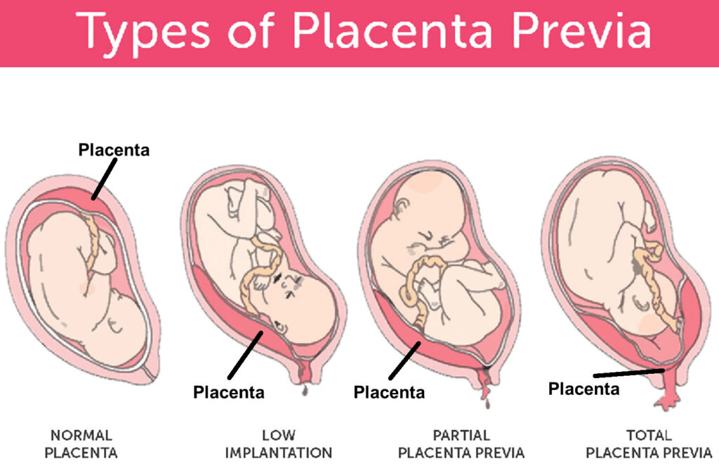 Abruptio Placentae Meaning Causes Symptoms Diagnosis And Management