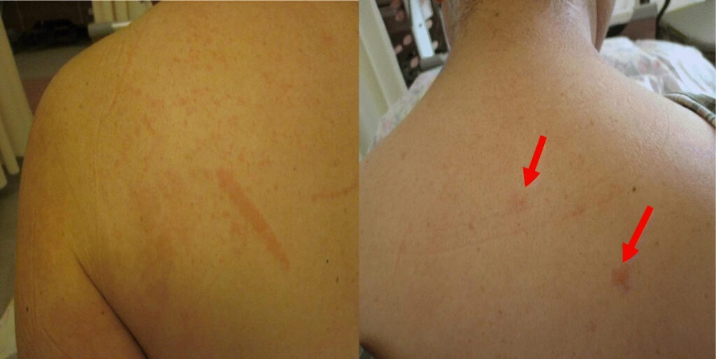 Adult Still's disease, causes, symptoms, diagnosis, prognosis & treatment