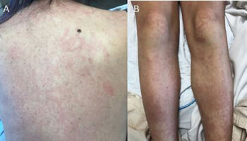 Adult onset still’s disease