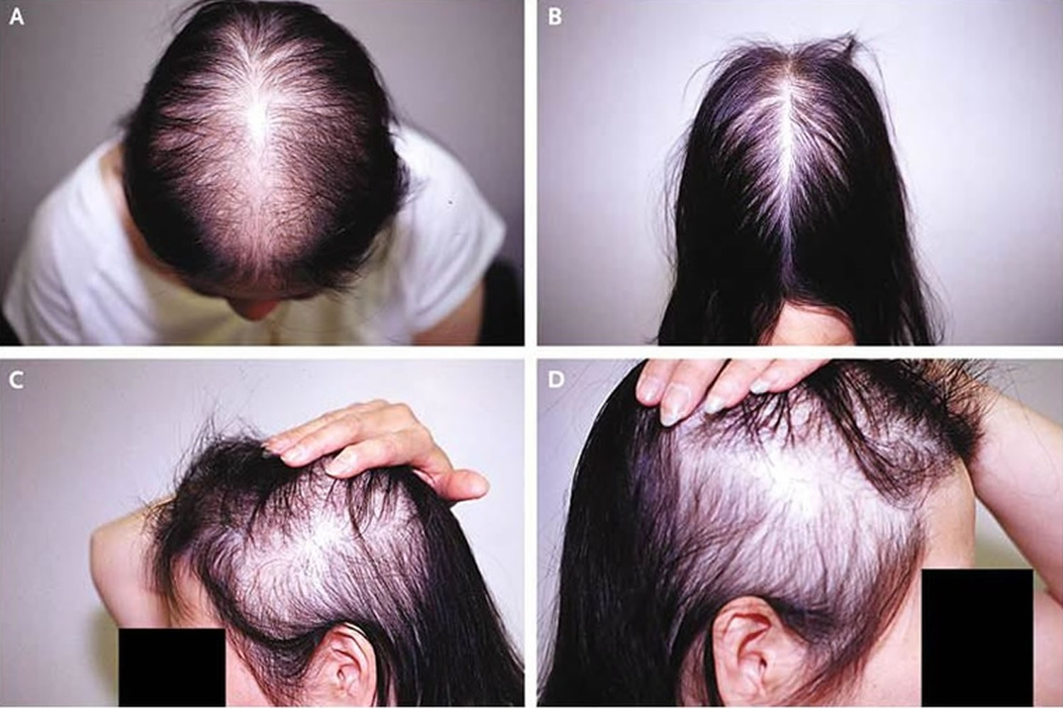 Study details relative efficacy of different drugs for treating Androgenic  alopecia