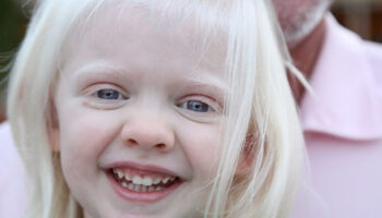 albinism