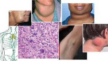 Hodgkin lymphoma
