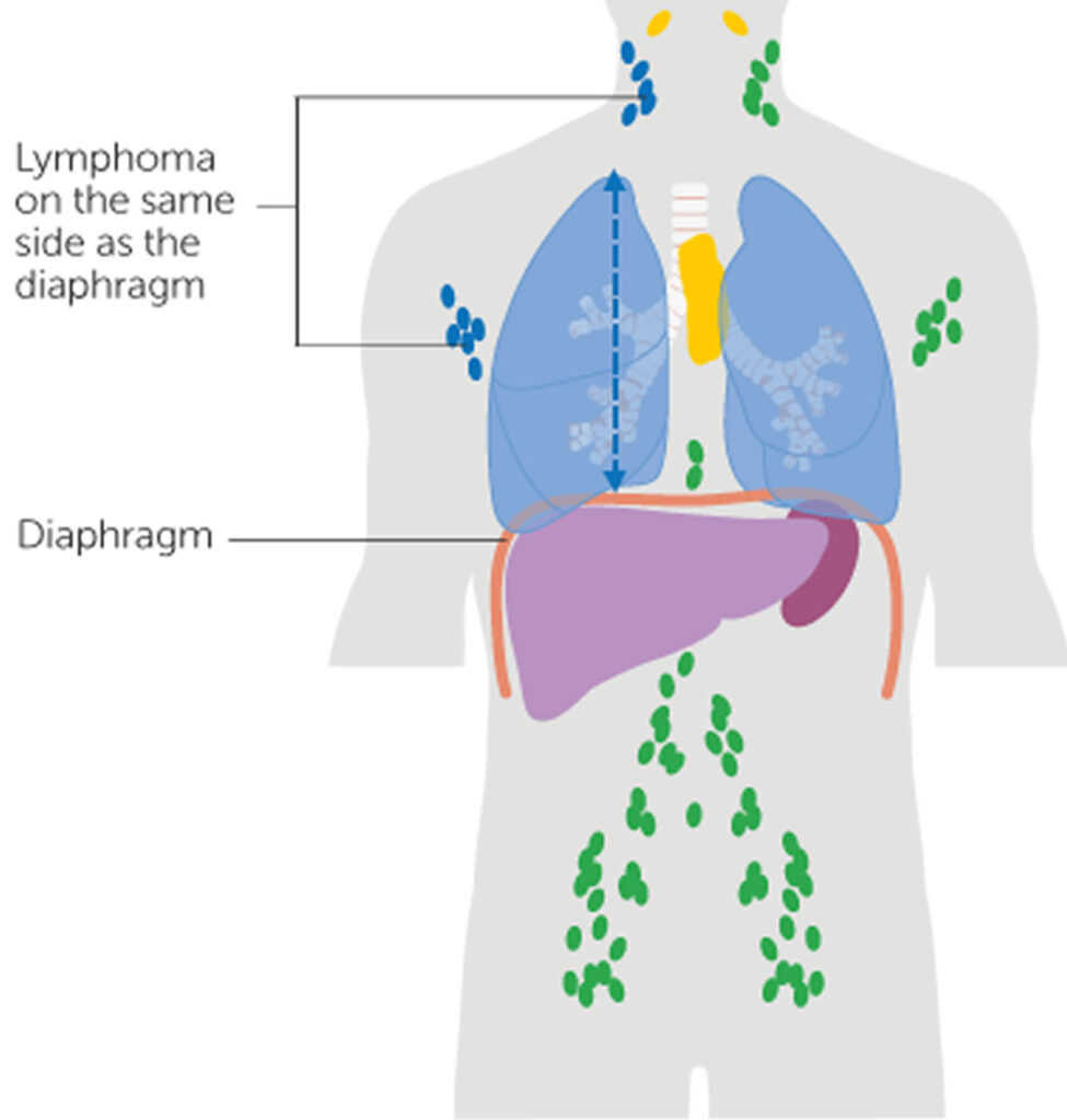 Hodgkin lymphoma causes, symptoms, diagnosis, stages, treatment & prognosis