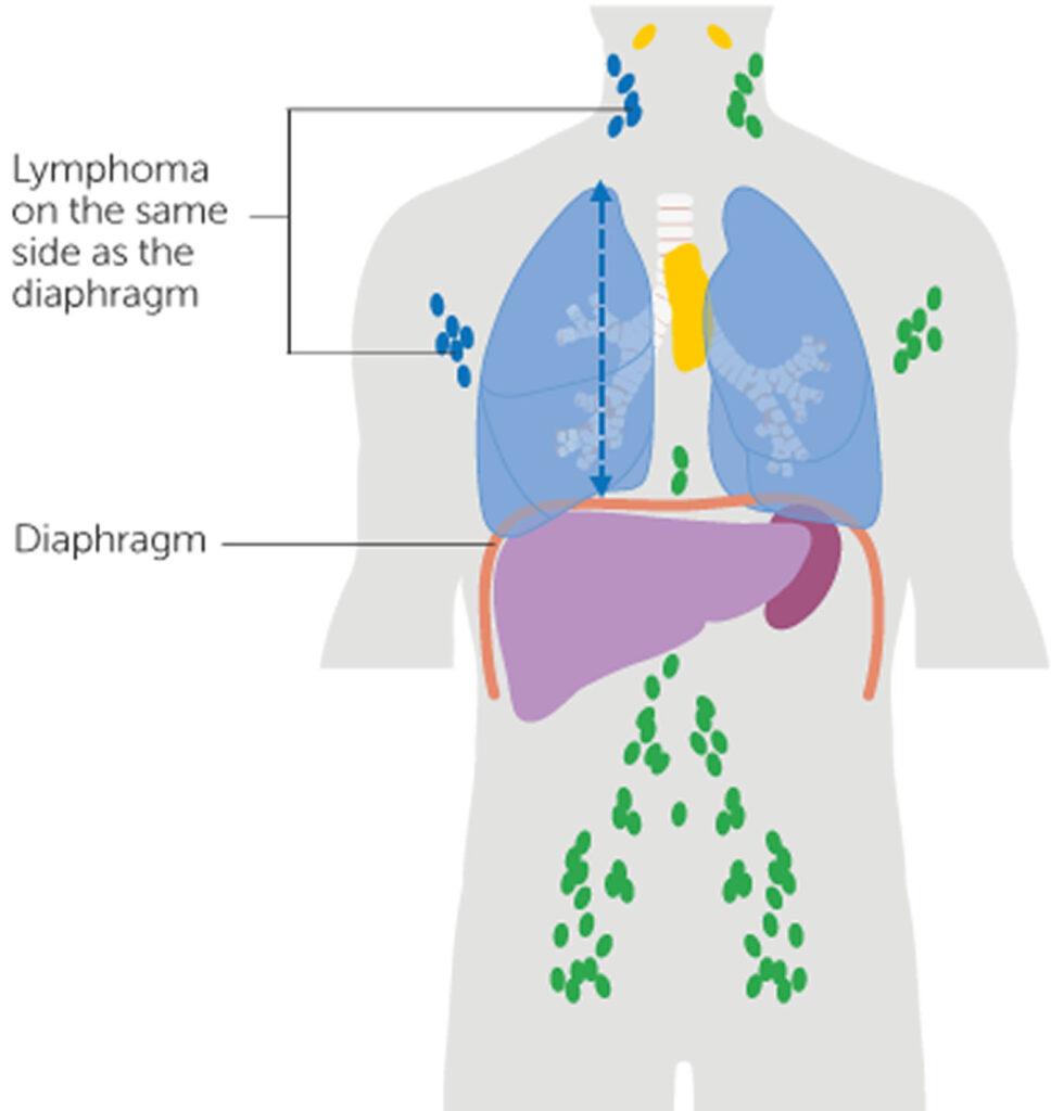 Non-Hodgkin Lymphoma causes, symptoms, diagnosis, treatment & prognosis