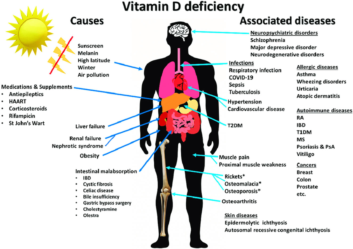 Vitamin D Deficiency Causes Symptoms Diagnosis Treatment