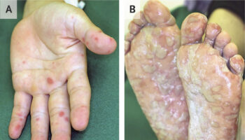 Hand foot and mouth disease