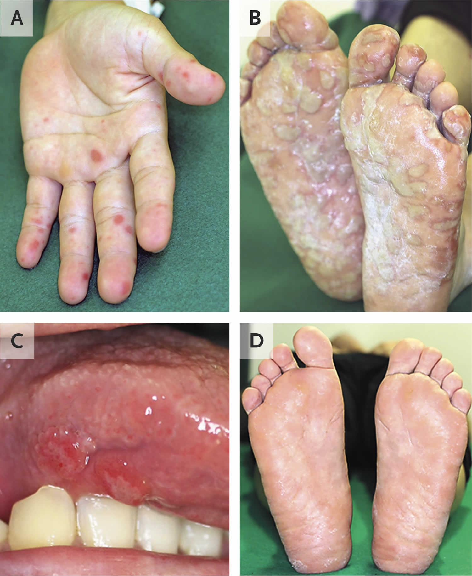 Blisters On Hands And Feet After Swimming