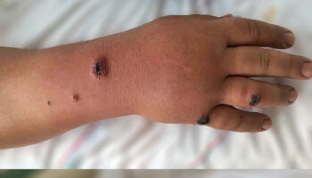 anthrax disease