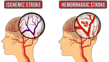 cva stroke