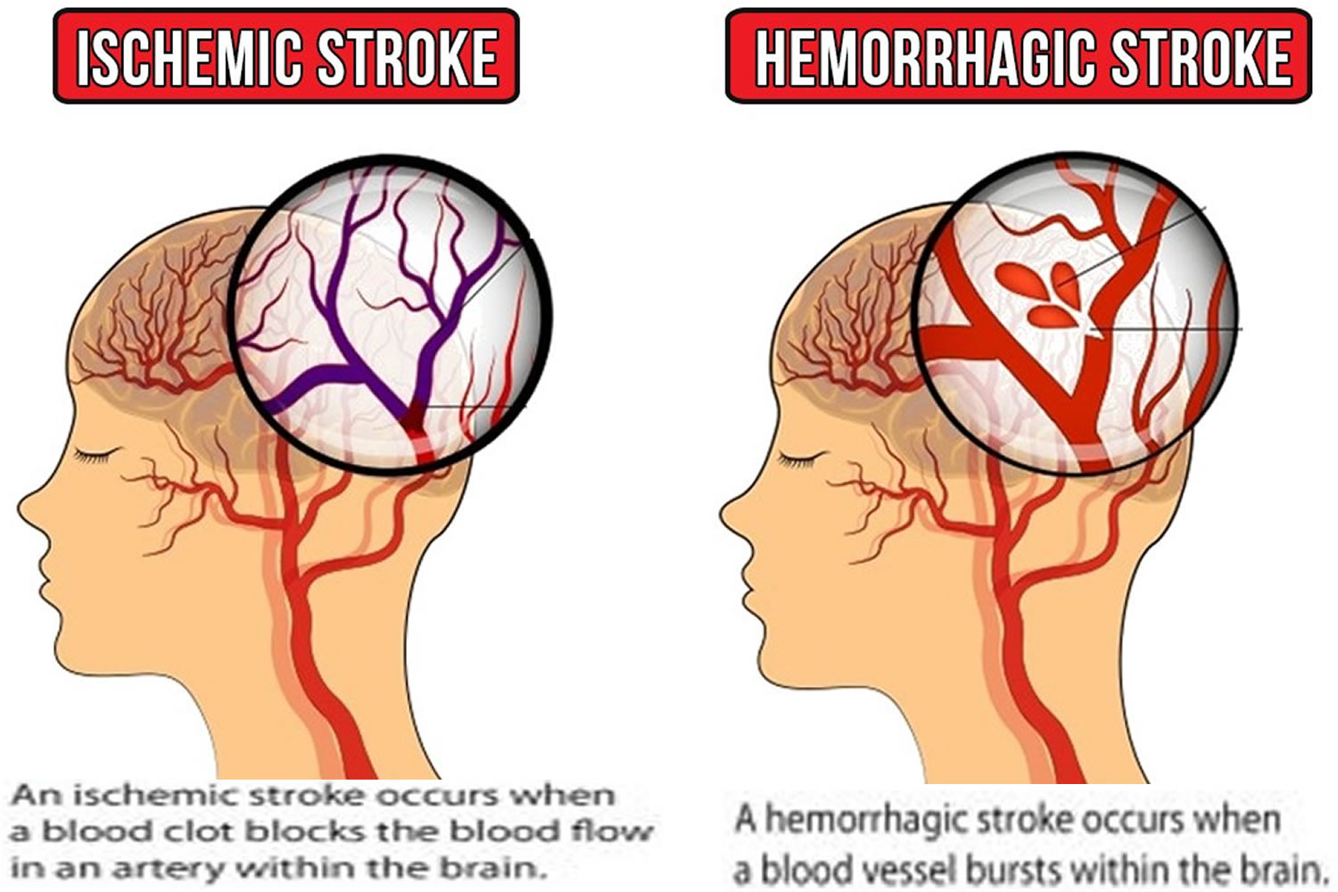 Cva Stroke Causes Symptoms Diagnosis Treatment Recovery And Prognosis