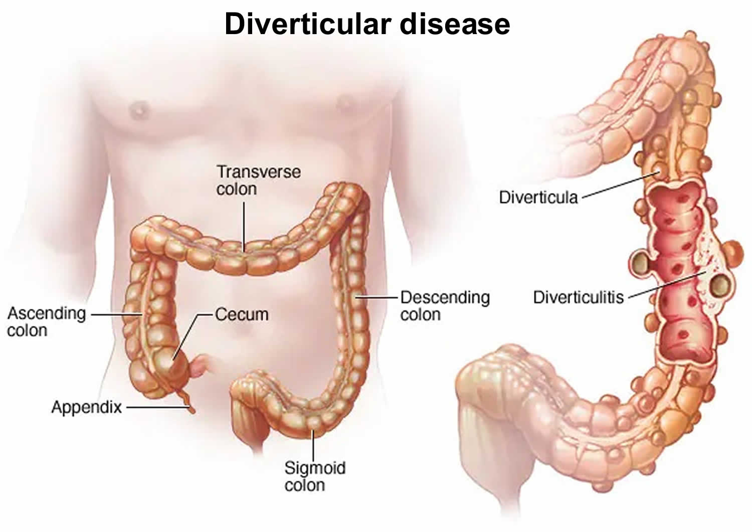 Diverticular disease. diverticular disease. 