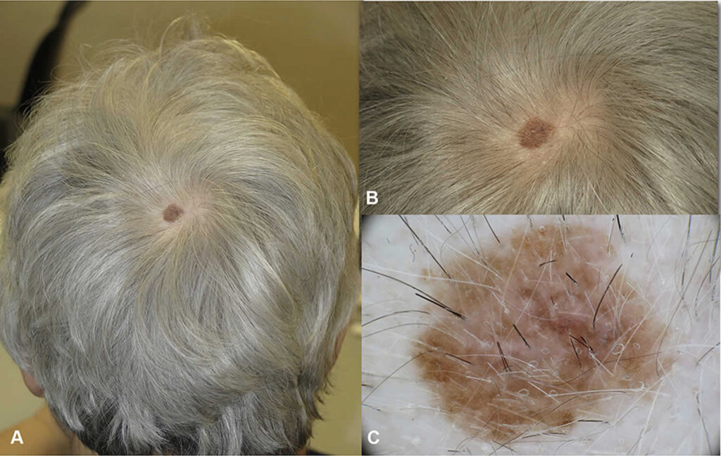 melanoma-causes-signs-symptoms-diagnosis-treatment-prognosis