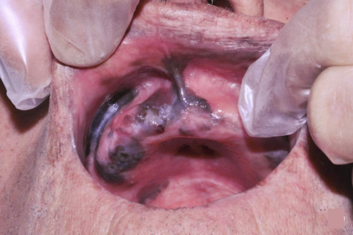 mucosal melanoma