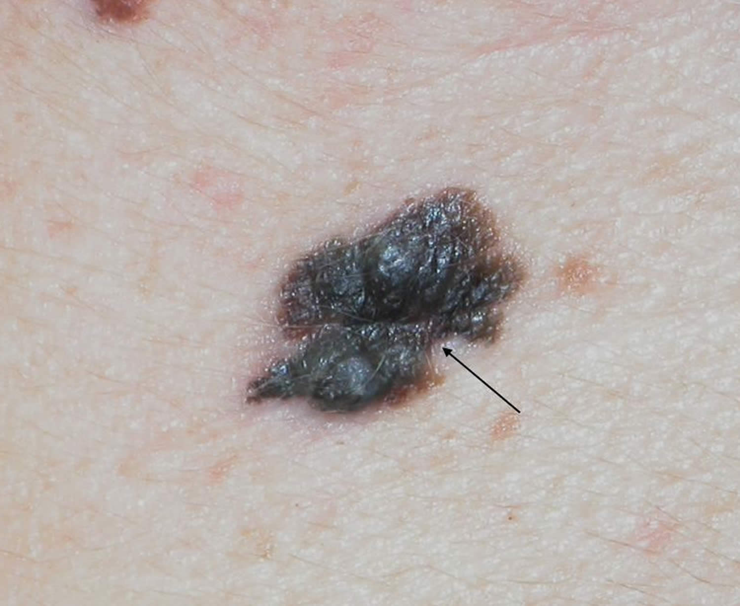 nodular melanoma