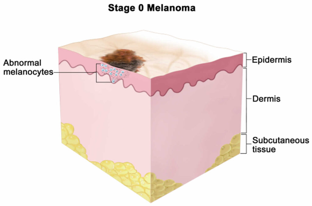 Acral lentiginous melanoma causes, symptoms, treatment & survival rate