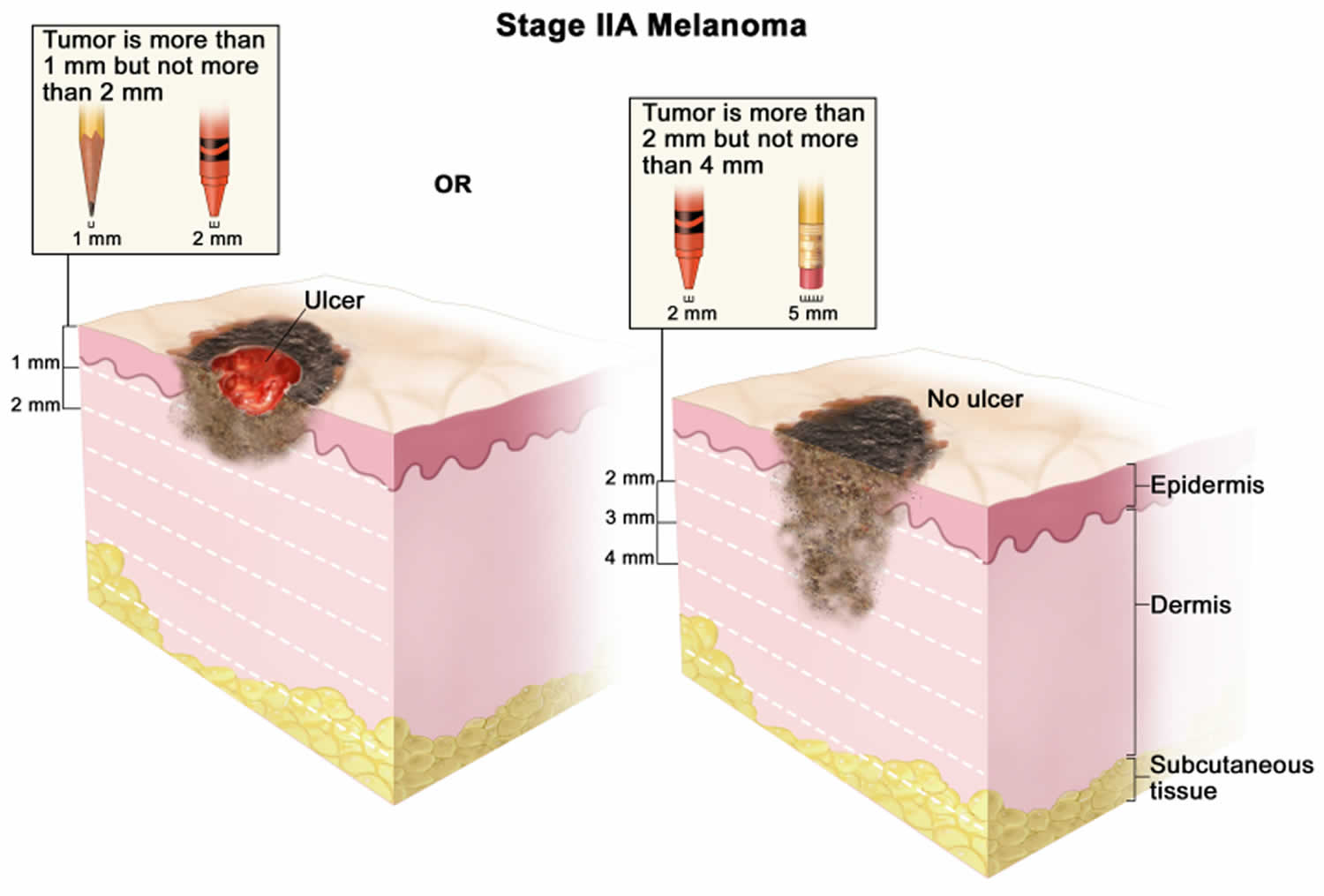 Stage 2A melanoma