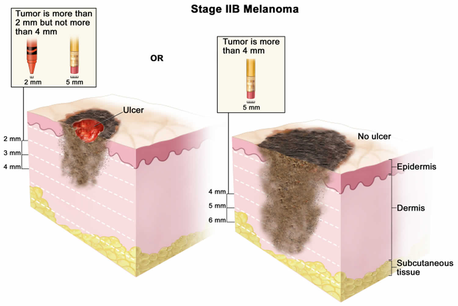 Stage 2B melanoma