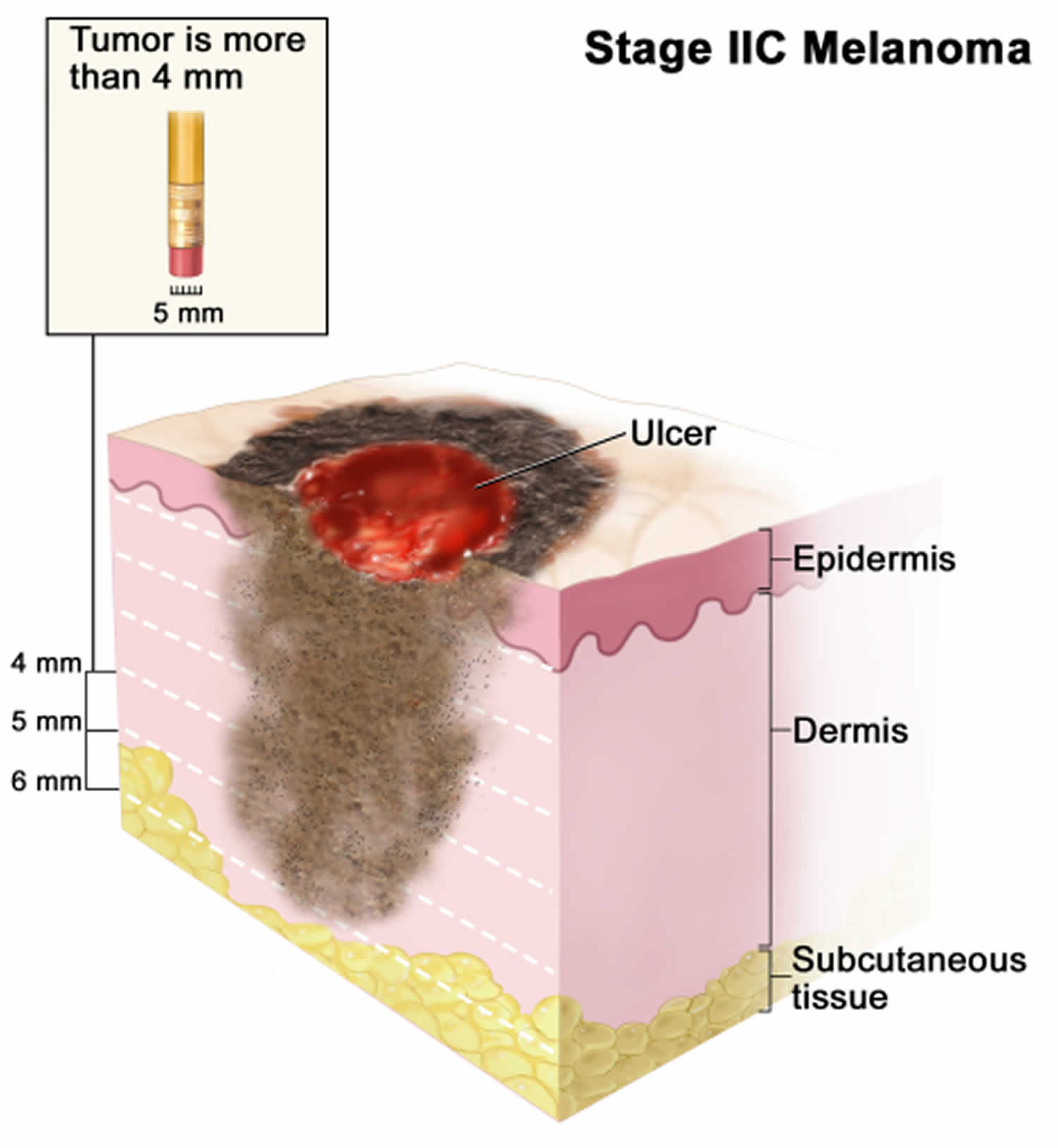 Stage 2C melanoma