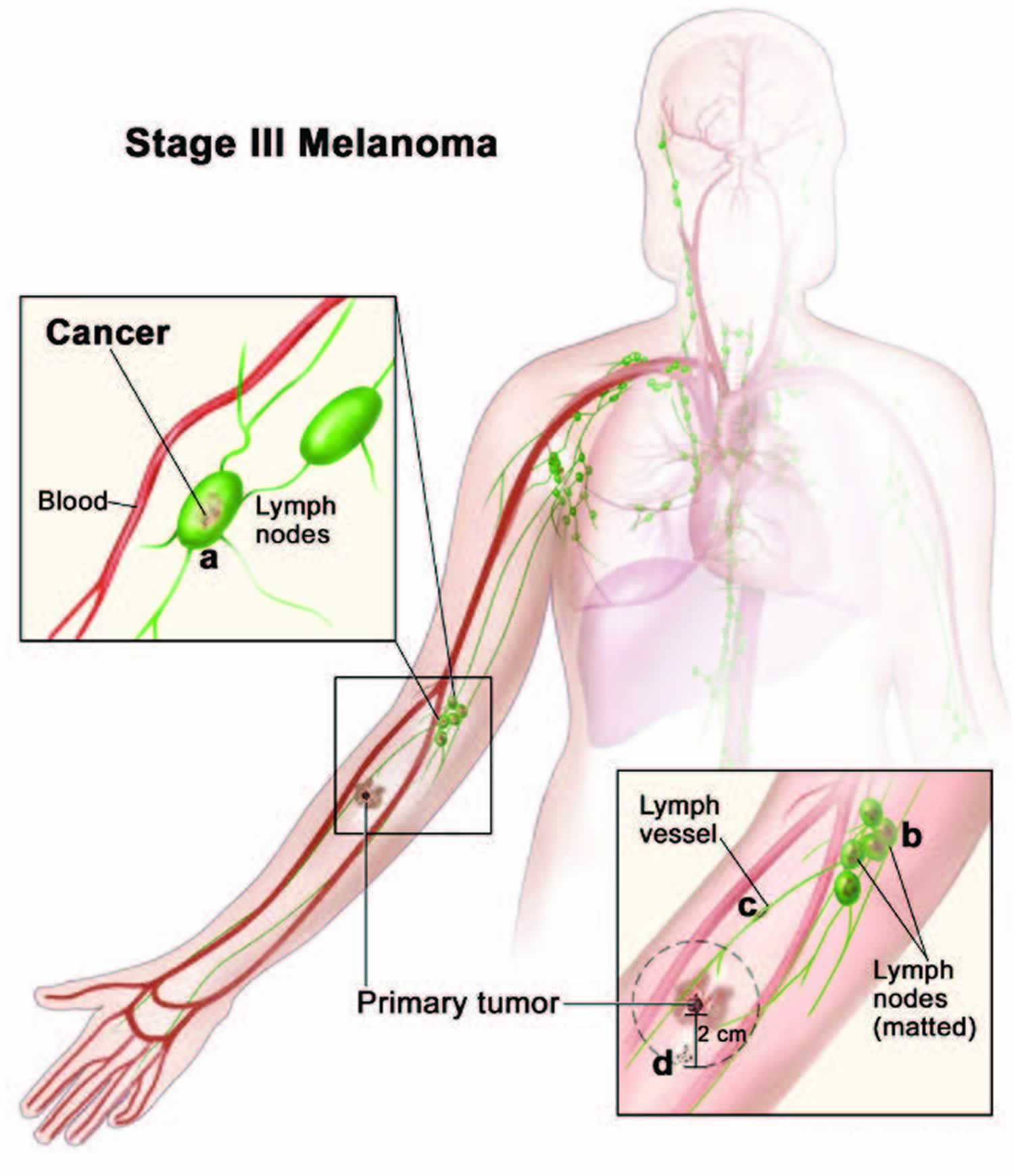Stage 3 melanoma
