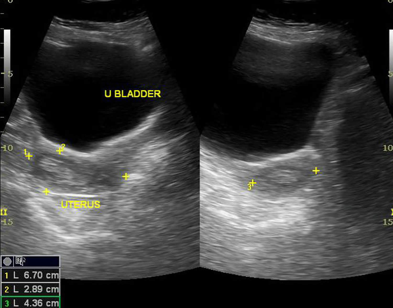 Endometrial hyperplasia ultrasound
