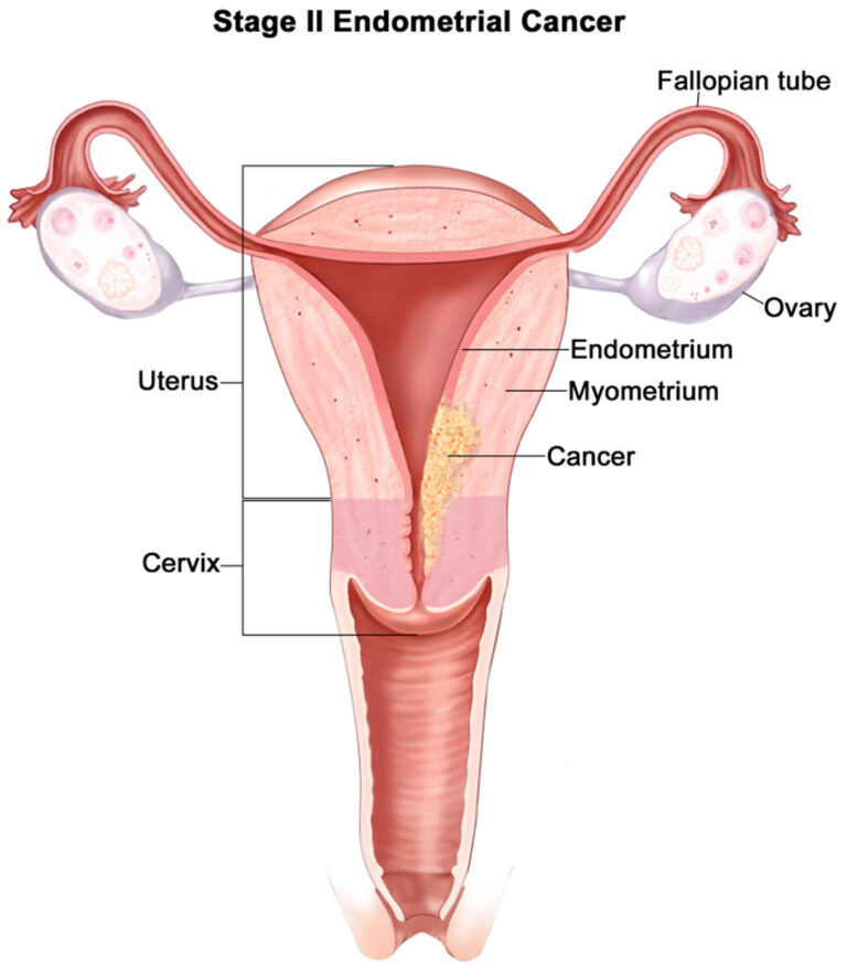 uterine-cancer-causes-symptoms-diagnosis-treatment-survival-rates