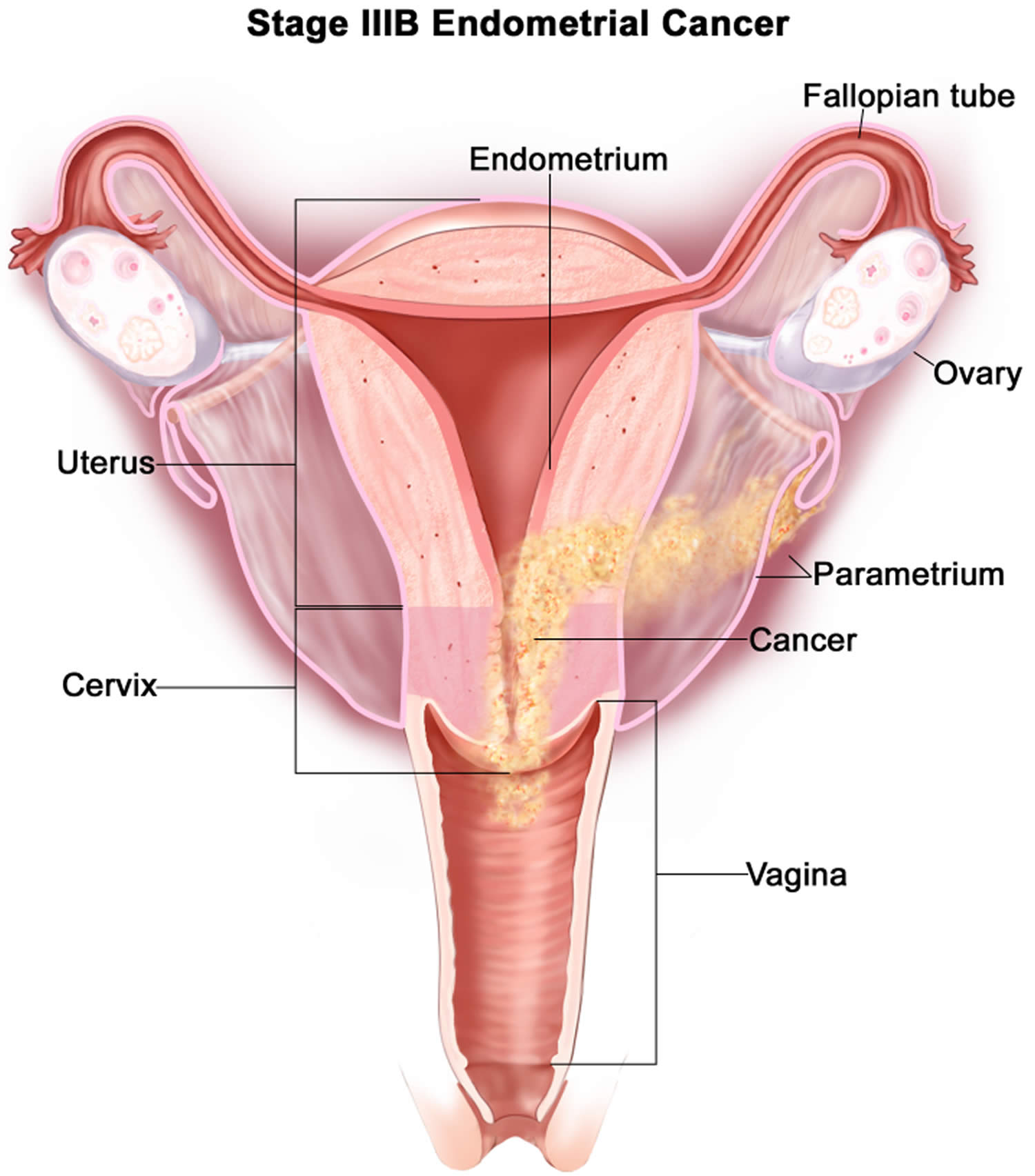Stage 3B uterine cancer
