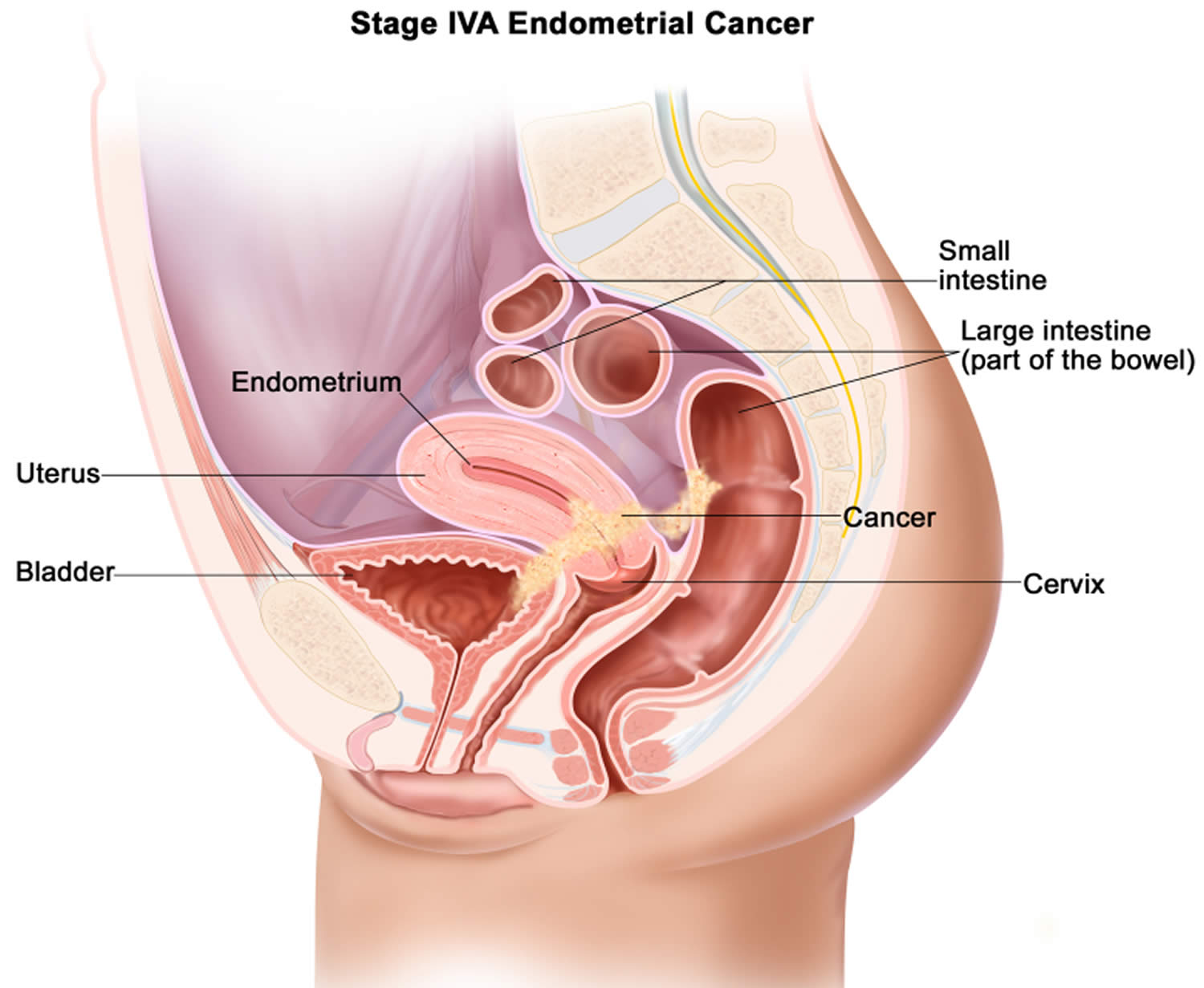 Stage 4A uterine cancer