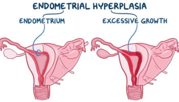 endometrial hyperplasia