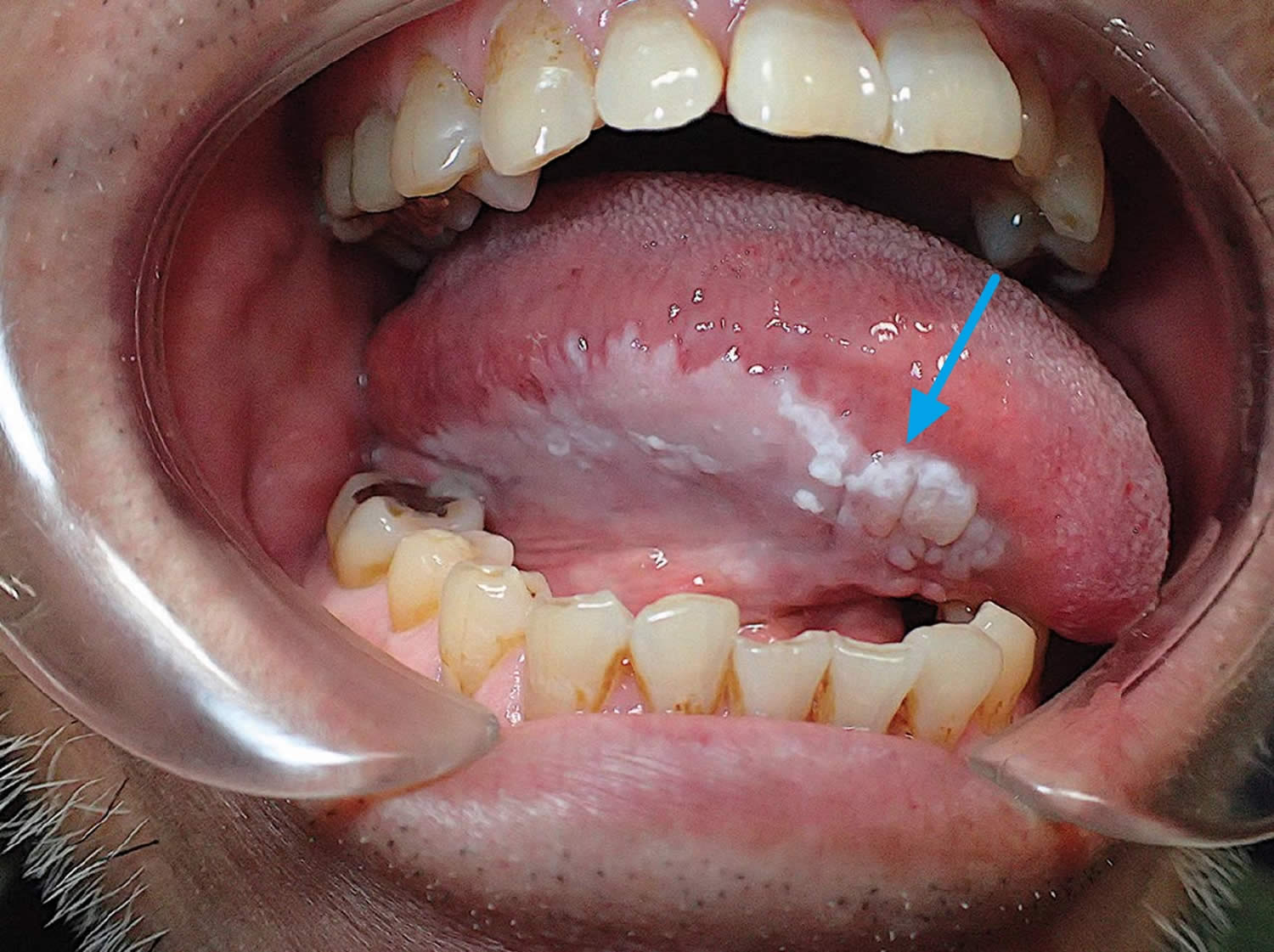 Oral leukoplakia