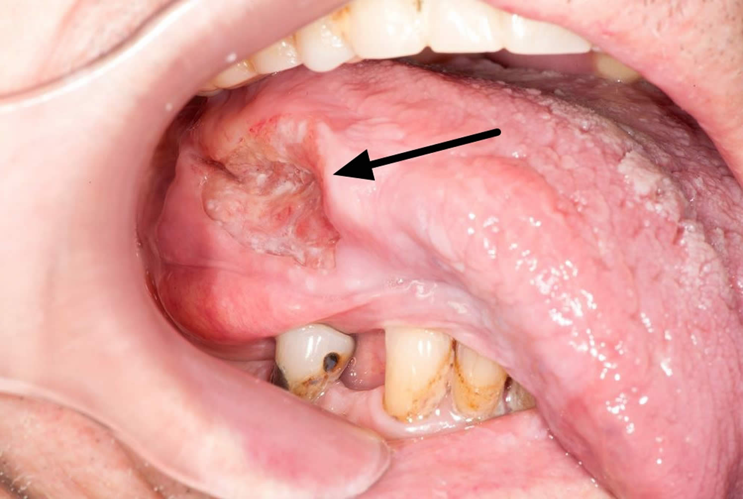 squamous cell cancer of the tongue