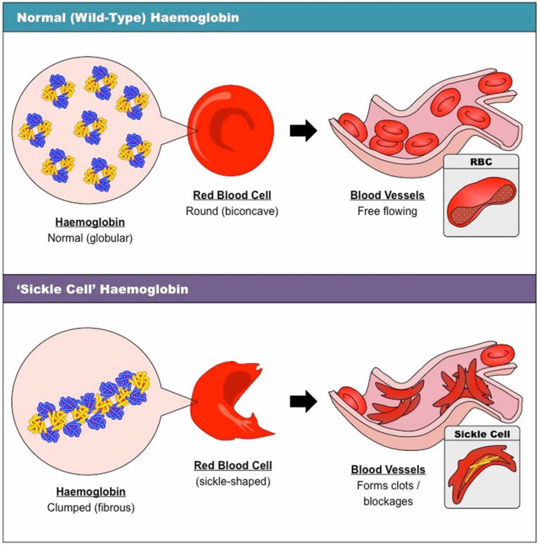 Sickle Cell Anemia, Causes, Fenetics, Symptoms, Diagnosis, Treatment ...