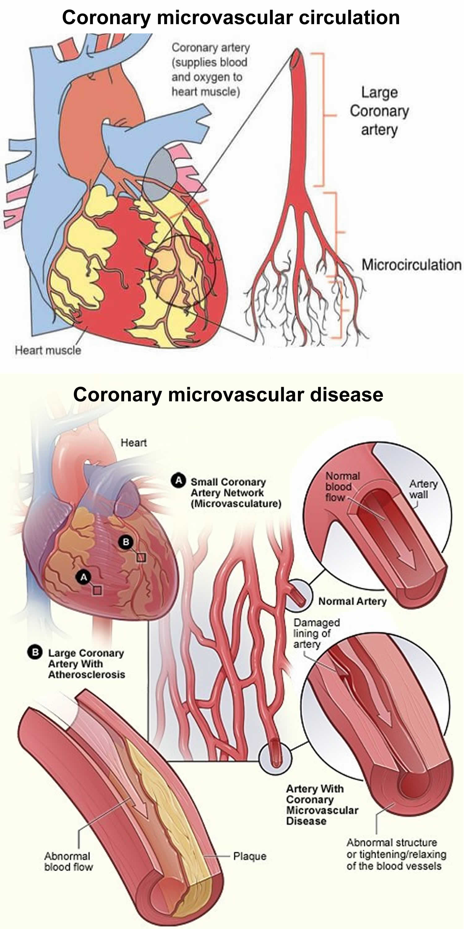 coronary microvascular disease