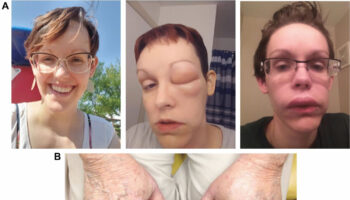 Hereditary angioedema