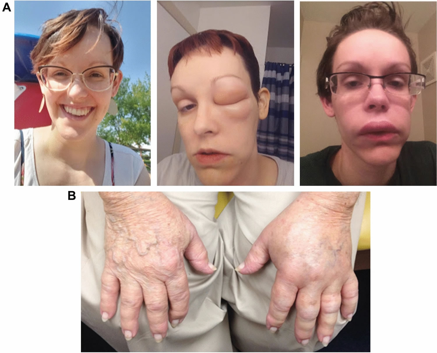 Hereditary Angioedema Causes Symptoms Diagnosis Treatment Prognosis