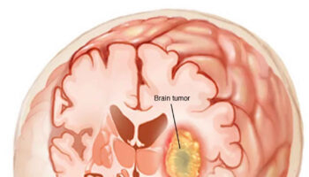 brain tumor