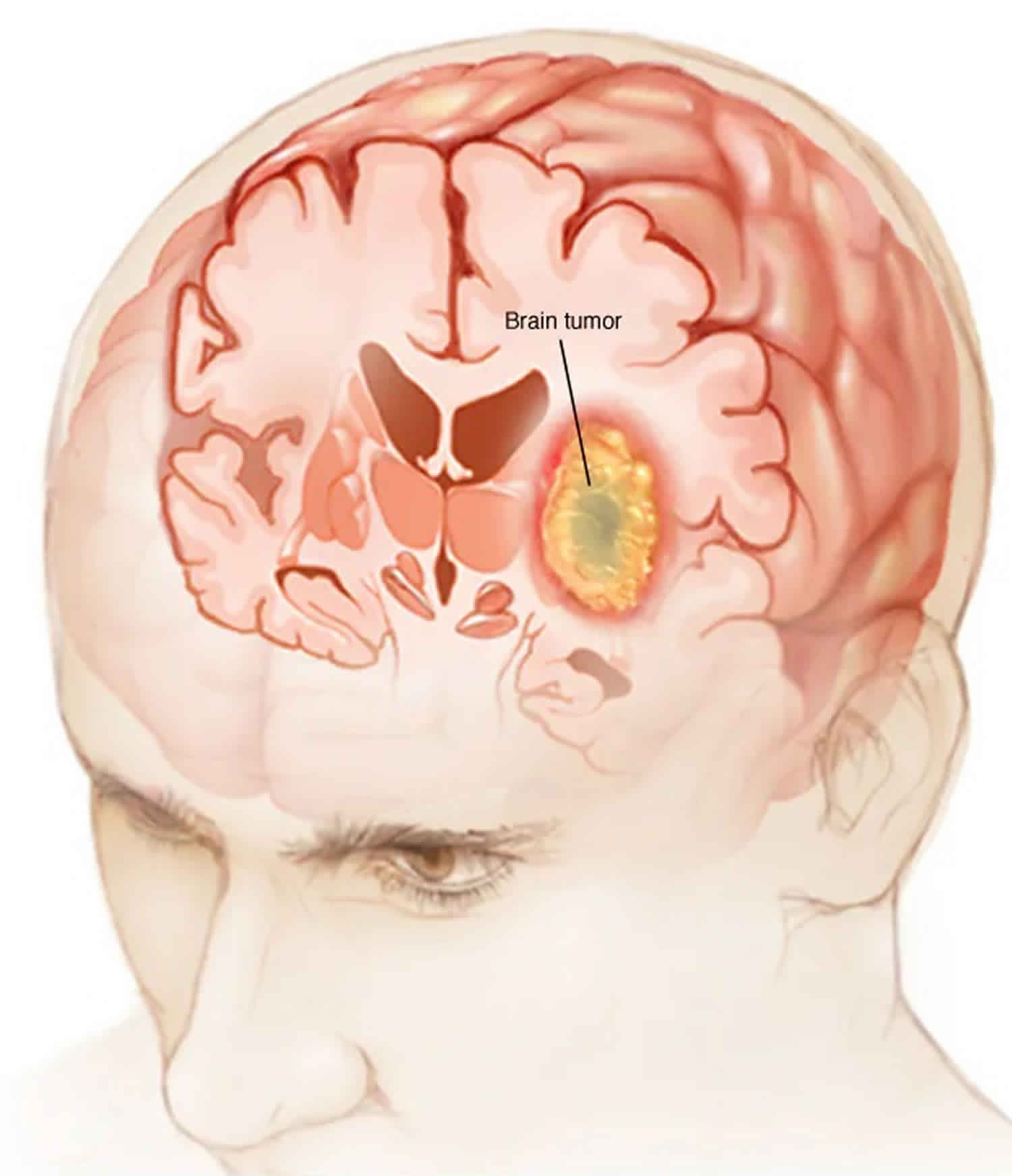 Brain Tumor Types Causes Symptoms Diagnosis Treatment Prognosis