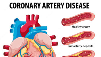 coronary artery disease