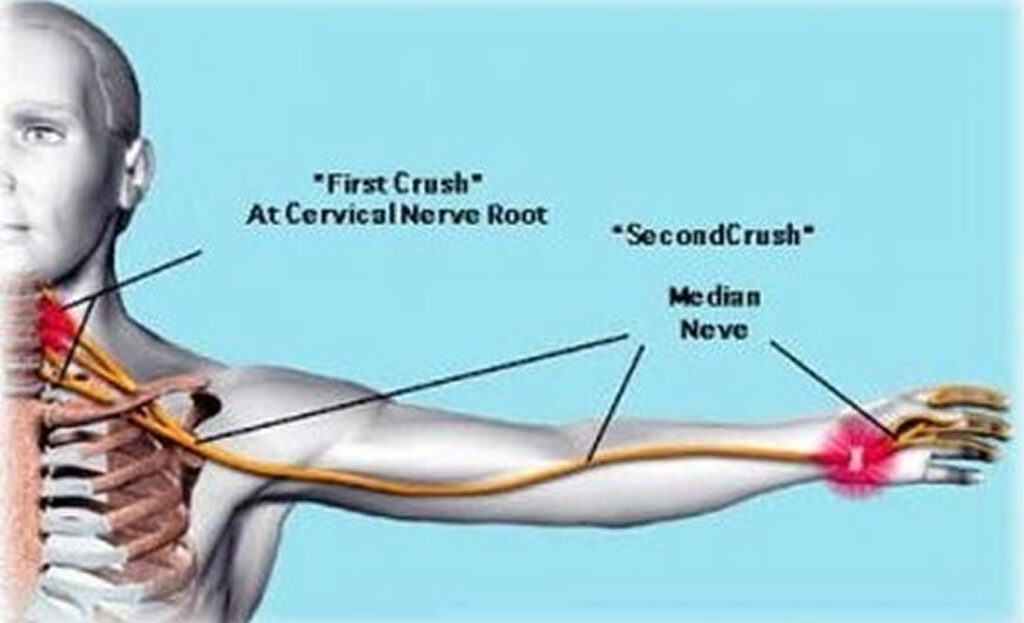 double-crush-syndrome-causes-signs-symptoms-diagnosis-treatment