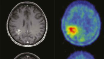 glioblastoma