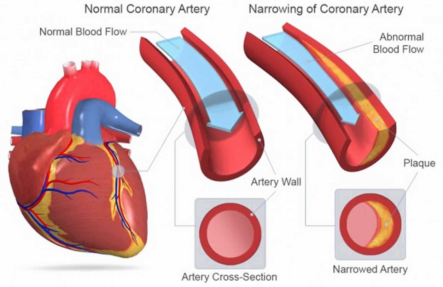 atherosclerosis blocking the coronary artery in the heart