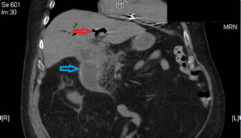 Bouveret syndrome