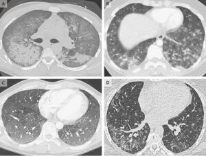 EVALI lung injury, causes, symptoms, diagnosis, treatment & prognosis