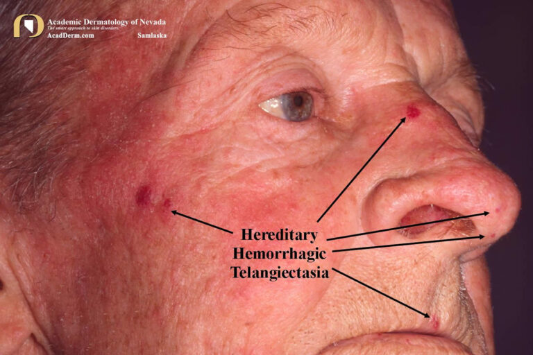 Hereditary hemorrhagic telangiectasia, causes, symptoms, diagnosis ...