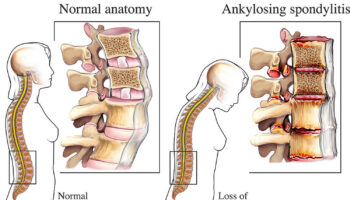 ankylosing spondylitis