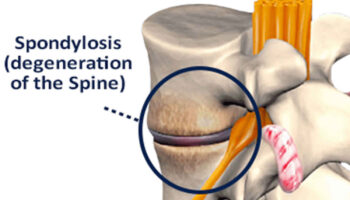 spondylosis