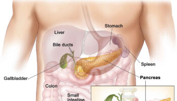 zollinger ellison syndrome