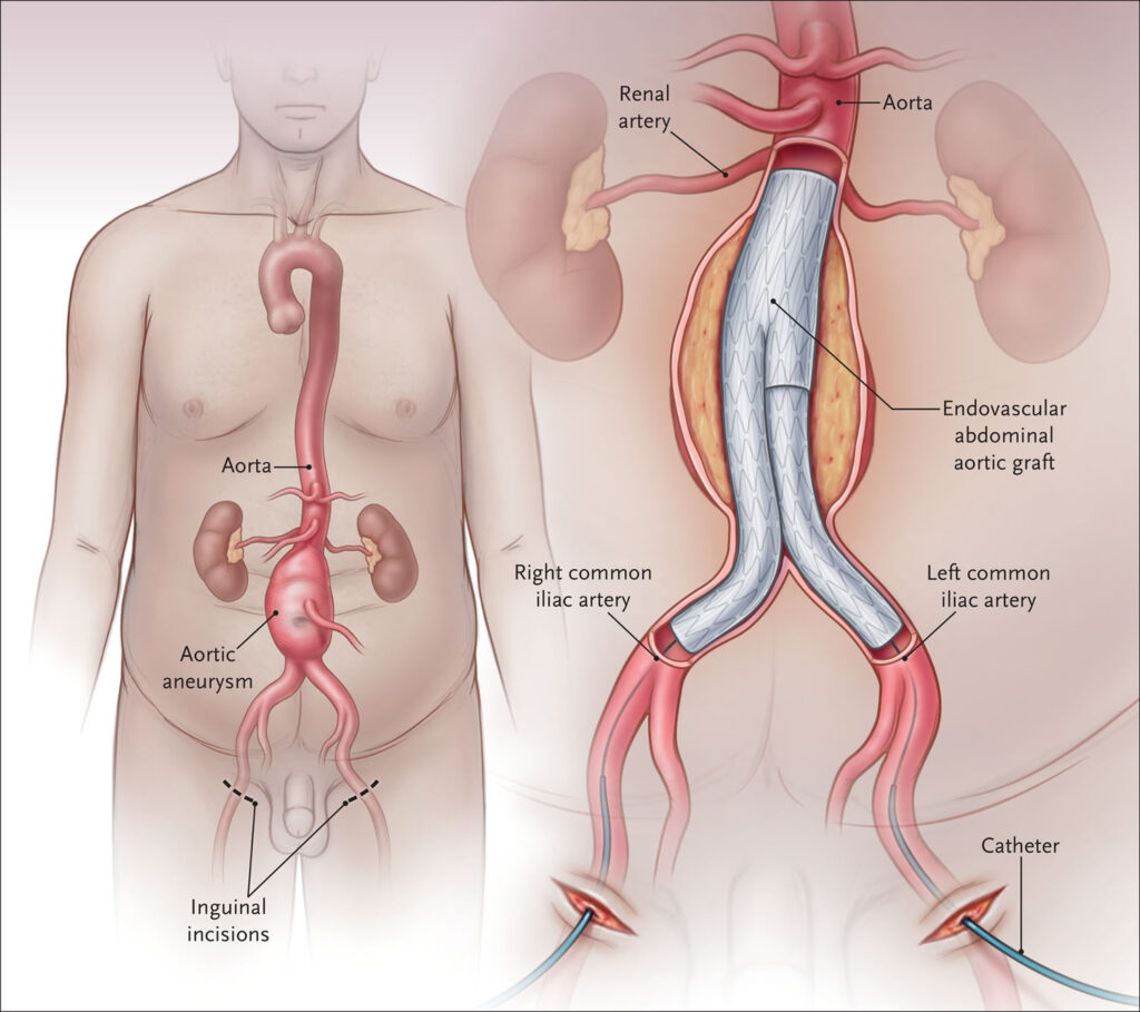 Abdominal Aortic Aneurysm Causes Symptoms Diagnosis Treatment