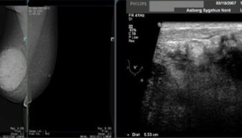 myofibroblastoma of breast