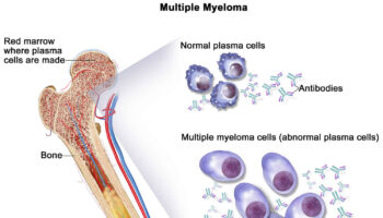 Plasma cell myeloma