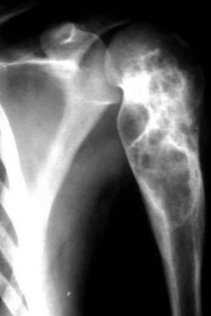 Aneurysmal bone cyst